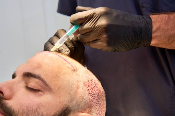 Hair Transplant in Dubai: Natural-Looking Results Explained